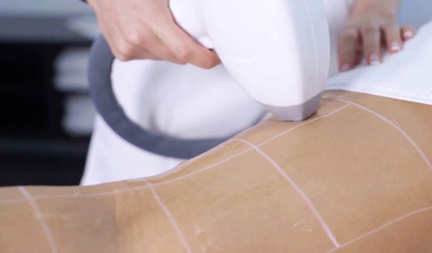 Why choose Elysion Laser?